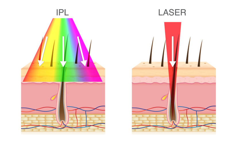 Warum Eignet Sich Der Diodenlaser Zur Haarentfernung Besser Als Ipl